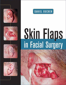 Buchen |  Skin Flaps in Facial Surgery | Buch |  Sack Fachmedien