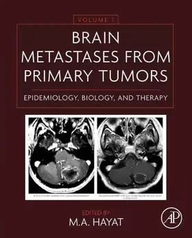 Hayat |  Brain Metastases from Primary Tumors Volume 1 | eBook | Sack Fachmedien