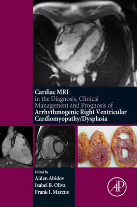 Abidov / Oliva / Marcus |  Cardiac MRI in Diagnosis, Clinical Management, and Prognosis of Arrhythmogenic Right Ventricular Cardiomyopathy/Dysplasia | eBook | Sack Fachmedien