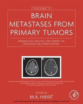 Hayat |  Brain Metastases from Primary Tumors, Volume 3 | eBook | Sack Fachmedien