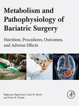 Rajendram AKC / Rajendram / R Martin RN |  Metabolism and Pathophysiology of Bariatric Surgery | eBook | Sack Fachmedien