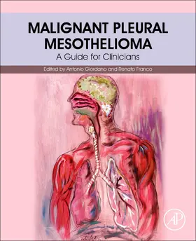 Giordano / Franco |  Malignant Pleural Mesothelioma | Buch |  Sack Fachmedien