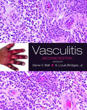 Ball / Bridges, Jr |  Vasculitis | Buch |  Sack Fachmedien