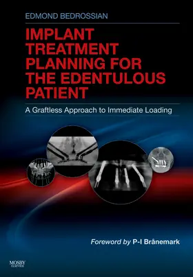 Bedrossian |  Implant Treatment Planning for the Edentulous Patient | Buch |  Sack Fachmedien