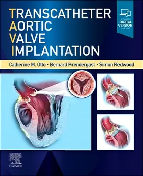 Otto / Prendergast / Redwood |  Transcatheter Aortic Valve Implantation | Buch |  Sack Fachmedien