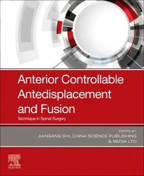 Shi |  Anterior Controllable Antedisplacement and Fusion | Buch |  Sack Fachmedien