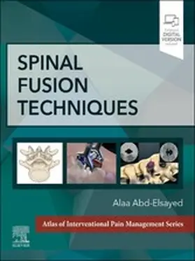 Abd-Elsayed MD / Abd-Elsayed |  Spinal Fusion Techniques - E-Book | eBook | Sack Fachmedien