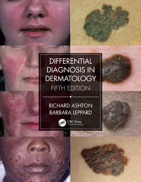 Leppard / Ashton |  Differential Diagnosis in Dermatology | Buch |  Sack Fachmedien