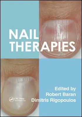 Baran / Rigopoulos |  Nail Therapies | Buch |  Sack Fachmedien