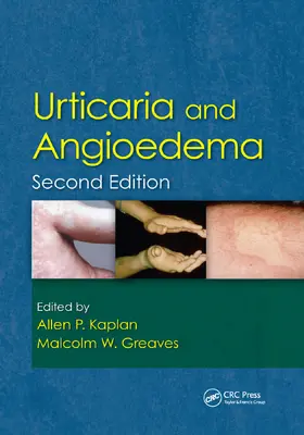 Kaplan / Greaves |  Urticaria and Angioedema | Buch |  Sack Fachmedien