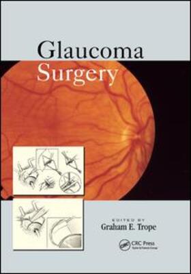 Trope |  Glaucoma Surgery | Buch |  Sack Fachmedien
