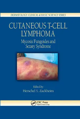 Zackheim |  Cutaneous T-Cell Lymphoma | Buch |  Sack Fachmedien