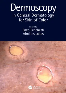 Lallas / Errichetti |  Dermoscopy in General Dermatology for Skin of Color | Buch |  Sack Fachmedien