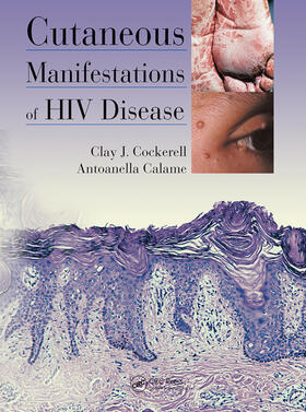 Cockerell / Calame |  Cutaneous Manifestations of HIV Disease | Buch |  Sack Fachmedien