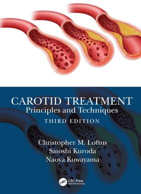 Loftus / Kuroda / Kuwayama |  Carotid Treatment: Principles and Techniques | Buch |  Sack Fachmedien