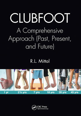 Mittal |  Clubfoot | Buch |  Sack Fachmedien