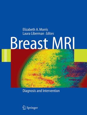 Liberman |  Breast MRI | Buch |  Sack Fachmedien