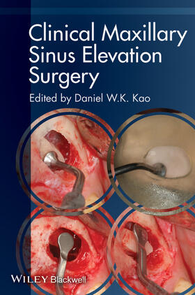 Kao |  Clinical Maxillary Sinus Elevation Surgery | Buch |  Sack Fachmedien