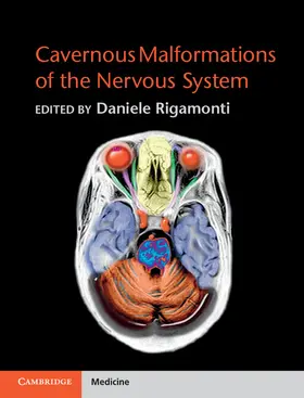 Rigamonti |  Cavernous Malformations of the Nervous System | Buch |  Sack Fachmedien