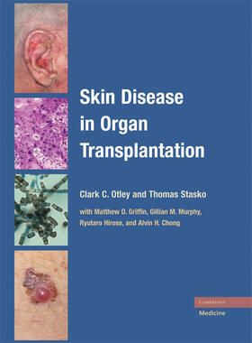 Otley / Stasko |  Skin Disease in Organ Transplantation | Buch |  Sack Fachmedien