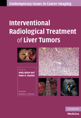 Adam / Mueller |  Interventional Radiological Treatment of Liver Tumors | Buch |  Sack Fachmedien