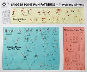 Travell / Simons |  Travell and Simons' Trigger Point Pain Patterns Wall Charts | Sonstiges |  Sack Fachmedien