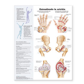 Understanding Arthritis Spanish | Sonstiges | 978-0-7817-7302-7 | sack.de