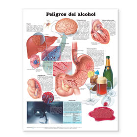  Dangers of Alcohol Anatomical Chart in Spanish (Peligros del alcohol) | Sonstiges |  Sack Fachmedien
