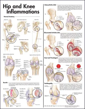  Hip and Knee Inflammations Anatomical Chart | Sonstiges |  Sack Fachmedien