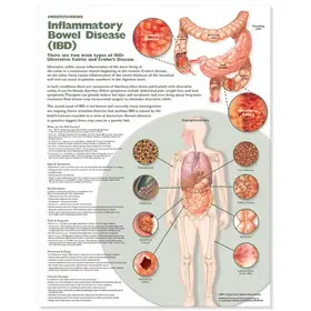  Understanding Inflammatory Bowel Disease (Ibd) Anatomical Chart | Sonstiges |  Sack Fachmedien