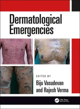 Verma / Vasudevan |  Dermatological Emergencies | Buch |  Sack Fachmedien