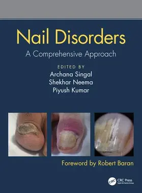 Singal / Neema / Kumar |  Nail Disorders | Buch |  Sack Fachmedien