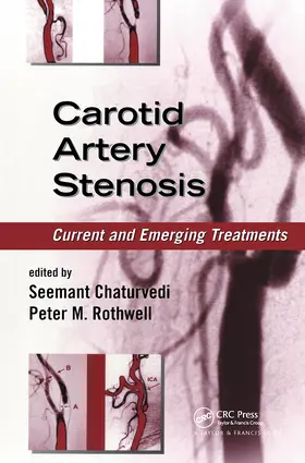 Chaturvedi / Rothwell |  Carotid Artery Stenosis | Buch |  Sack Fachmedien