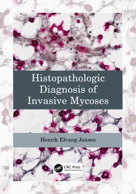 Jensen |  Histopathologic Diagnosis of Invasive Mycoses | Buch |  Sack Fachmedien