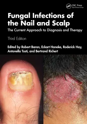 Tosti / Baran / Richert-Baran |  Fungal Infections of the Nail and Scalp | Buch |  Sack Fachmedien