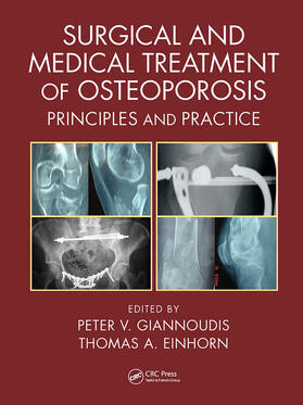Giannoudis / Einhorn |  Surgical and Medical Treatment of Osteoporosis | Buch |  Sack Fachmedien