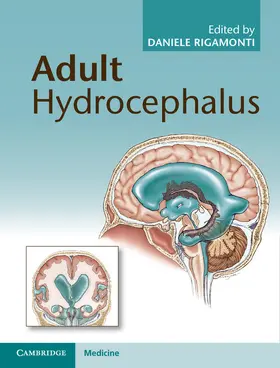 Rigamonti |  Adult Hydrocephalus | Buch |  Sack Fachmedien