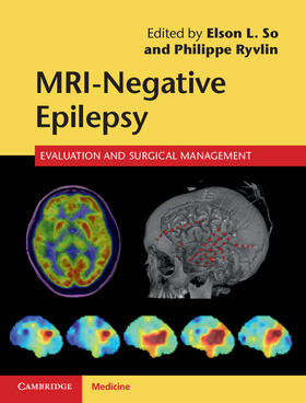 So / Ryvlin |  Mri-Negative Epilepsy | Buch |  Sack Fachmedien