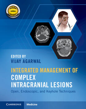 Agarwal |  Integrated Management of Complex Intracranial Lesions Hardback Set and Static Online Product | Buch |  Sack Fachmedien