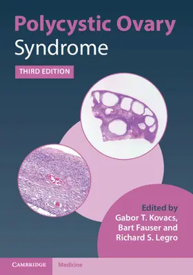 Fauser / Kovacs / Legro |  Polycystic Ovary Syndrome | Buch |  Sack Fachmedien