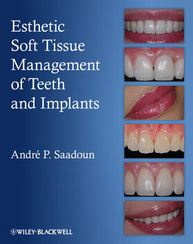 Saadoun |  Esthetic Soft Tissue Management of Teeth and Implants | Buch |  Sack Fachmedien