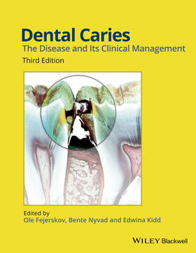 Fejerskov / Nyvad / Kidd |  Dental Caries | Buch |  Sack Fachmedien