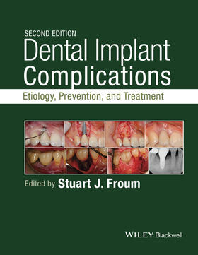 Froum |  Dental Implant Complications | Buch |  Sack Fachmedien