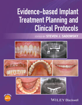 Sadowsky |  Evidence-Based Implant Treatment Planning and Clinical Protocols | Buch |  Sack Fachmedien