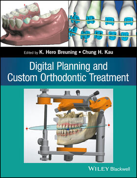 Breuning / Kau |  Digital Planning and Custom Orthodontic Treatment | Buch |  Sack Fachmedien