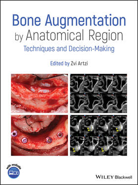 Artzi |  Bone Augmentation by Anatomical Region | Buch |  Sack Fachmedien