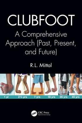 Mittal |  Clubfoot | Buch |  Sack Fachmedien