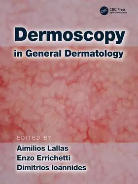 Lallas / Ioannides / Errichetti |  Dermoscopy in General Dermatology | Buch |  Sack Fachmedien