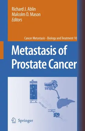 Mason / Ablin |  Metastasis of Prostate Cancer | Buch |  Sack Fachmedien