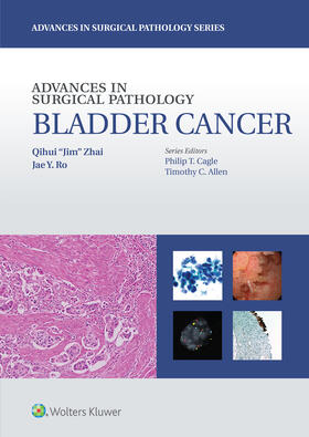 Zhai / Ro |  Advances in Surgical Pathology: Bladder Cancer | Buch |  Sack Fachmedien